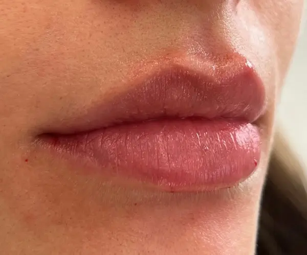 Lips after