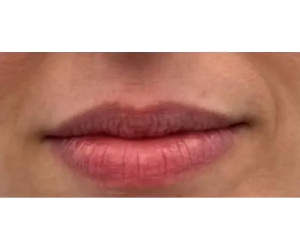 Lips before
