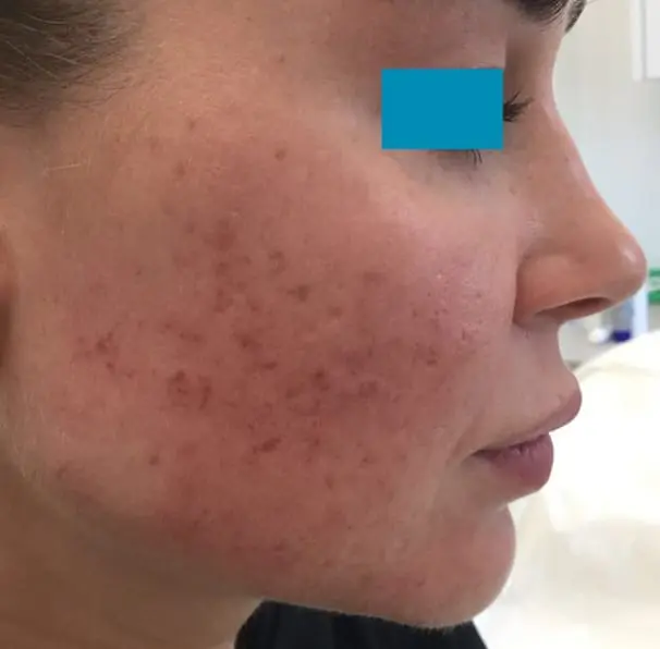 Laser Acne Treatment - Before 02