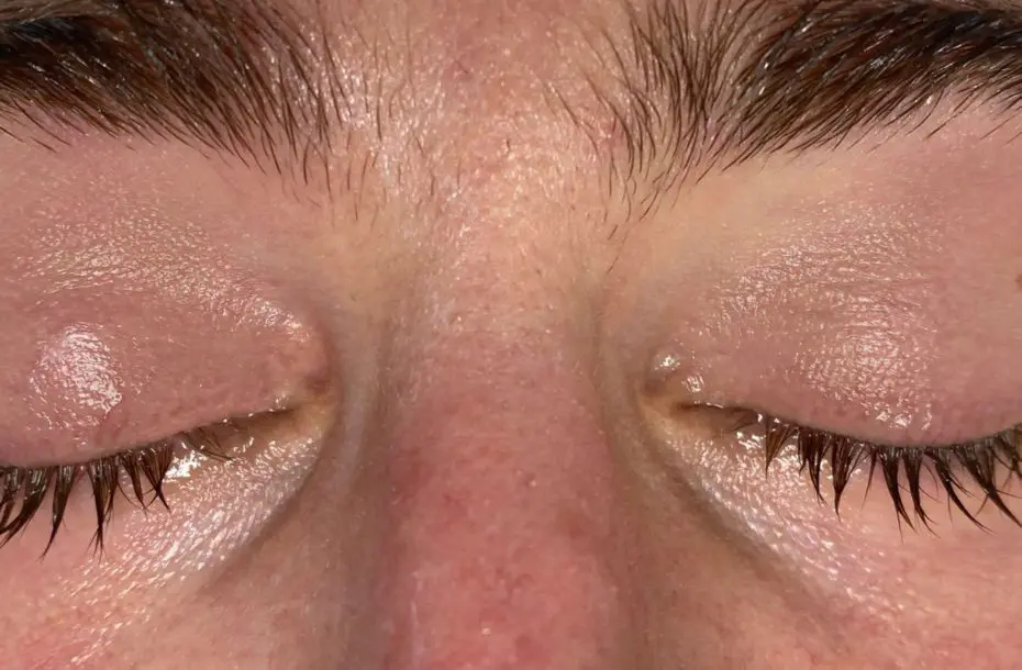 Eyelid / Periorbital Vein Laser