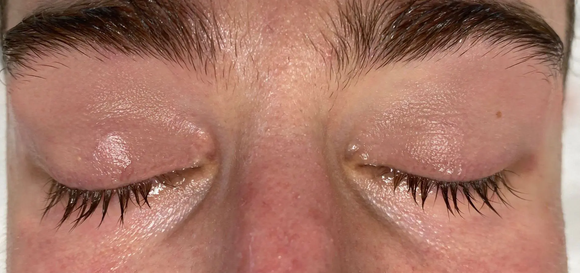 Eyelid / Periorbital Vein Laser