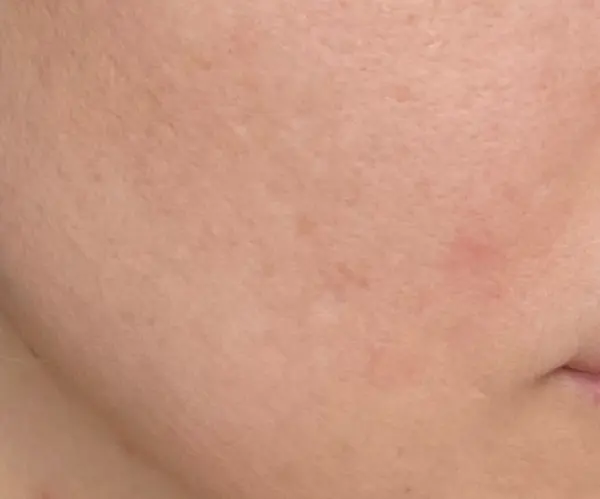PicoFX Resurfacing therapy after