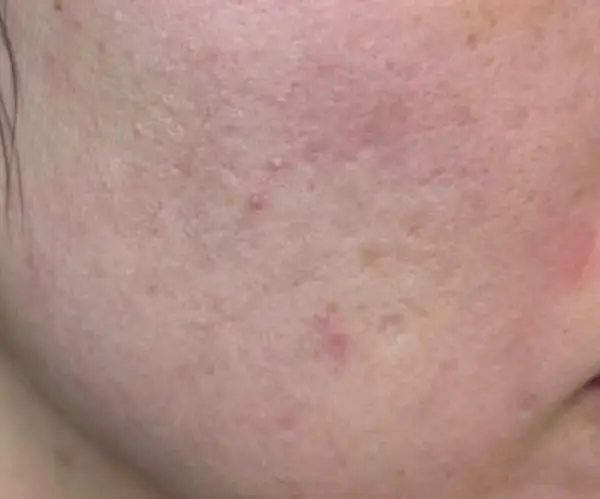 PicoFX Resurfacing therapy before