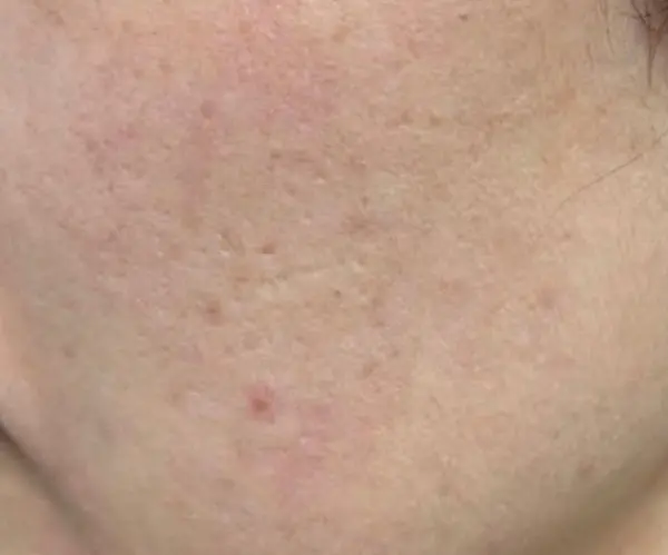 PicoFX Resurfacing therapy before